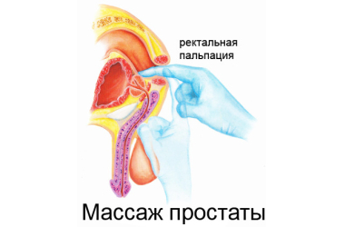 Урологический массаж. Профилактика мужских заболеваний после 40 лет