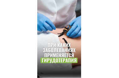 Гирудотерапия в Алматы от опытного врача гирудотерапевта женщины