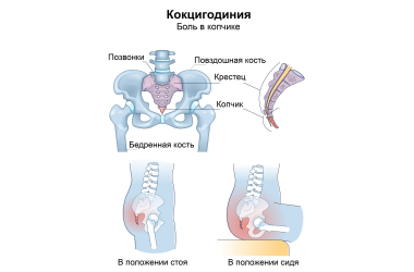 Не можете сидеть из-за боли в копчике?   Это кокцигодиния